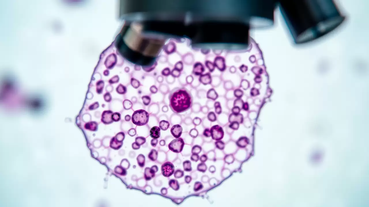 Combinația de medicamente reduce cu 37% progresia cancerului de prostată avansat