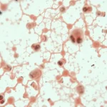 Știre despre boli, boli cardiovasculare și cancer