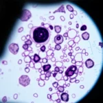 Știre despre cancer, celule și ferroptosis